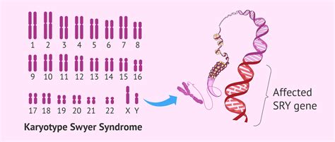 swyer syndrome causes clinical manifestations and pregnancy