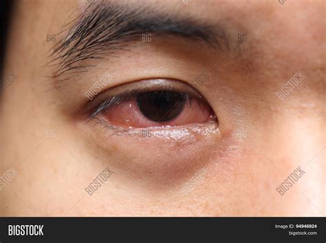 Red Sore Allergy Eye Image And Photo Free Trial Bigstock