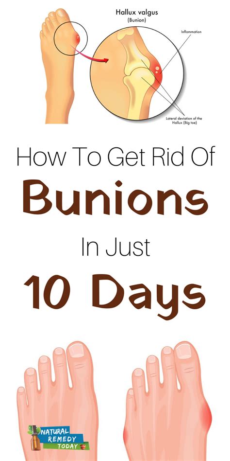 Get Rid Of Bunions Bone Deformity In Just 10 Days At Home With