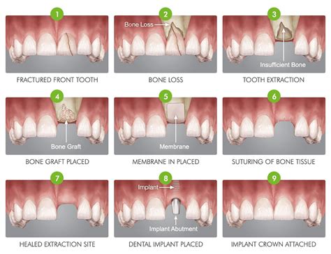 Bone Graft Mexico Price List All Types Of Dental Grafts Dental