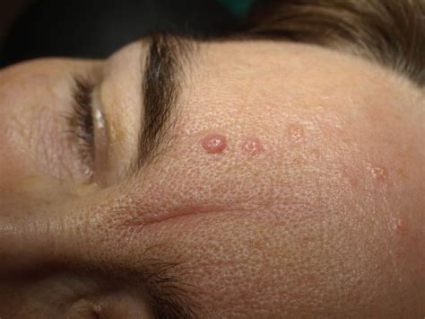 Sebaceous Hyperplasia Causes Symptoms And Treatments
