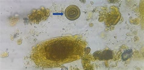 Pathology Outlines Urine Crystals And Microscopy