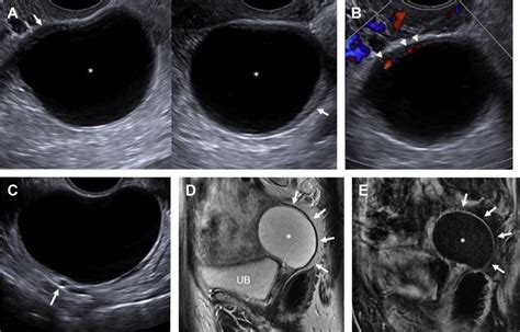 Imaging Of Acute Pelvic Pain Radiologic Clinics