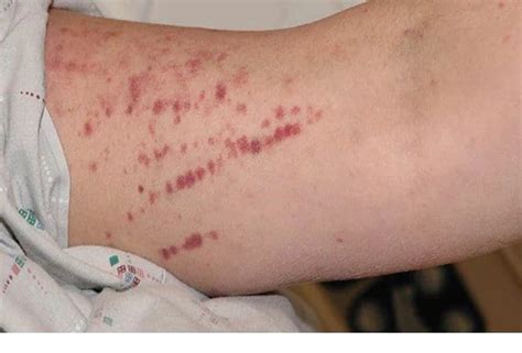 14 Skin Lesions Caused By Cancer Chemotherapy