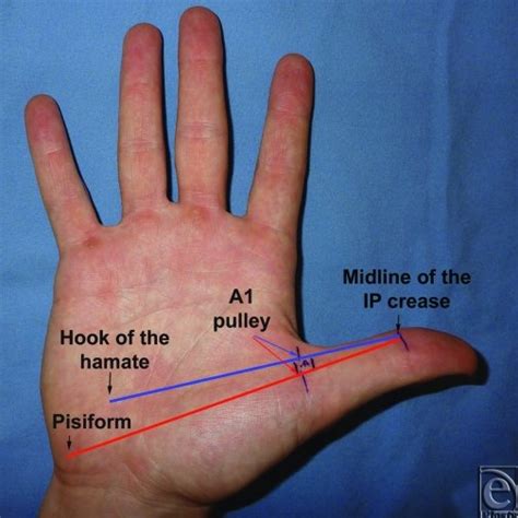 Proposed Longitudinal Anatomic Landmarks For The Thumb A1 Pulley The