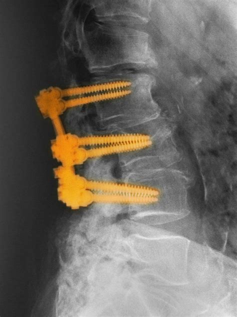 Spinal Muscular Atrophy Surgery Rare Disease Advisor