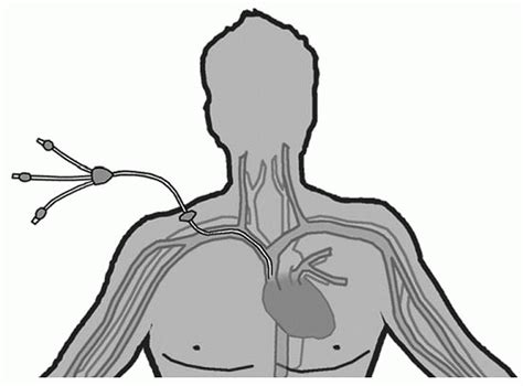 Central Venous Access Nurse Key