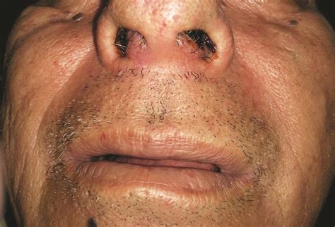 Swelling Of The Nasal Septum A Case Of Nasal Septum Carcinoma