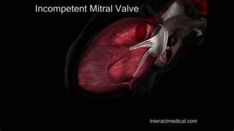 Mitral Valve Normal And Incompetent Youtube