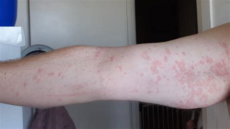 Geelong Rash Health Authorities Investigating Skin Condition After