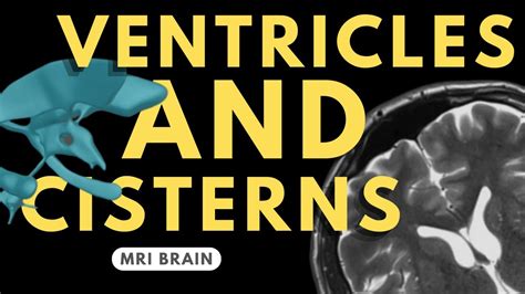 Ventricles And Cisterns Of The Brain Radiology Anatomy Part 1 Prep