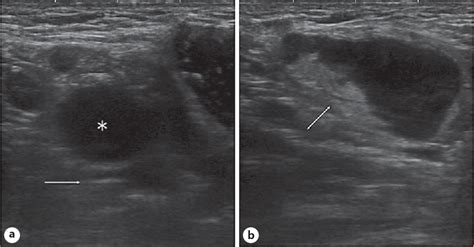Figure 1 From Unilateral Axillary Lymphadenopathy Due To Toxoplasmosis