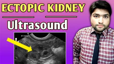 Ectopic Kidney Ultrasound What Is Ectopic Kidney By Dr Ali Waqar