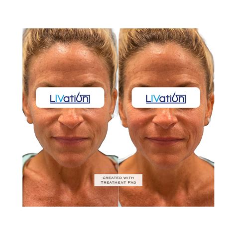 Mini Facelifts In Madison Ct Non Invasive Facelift Treatments