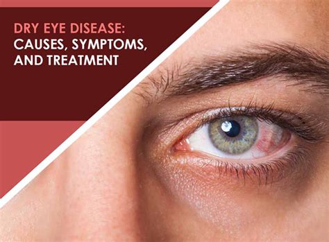 Dry Eye Syndrome Causes Symptoms And Treatment How To Relief