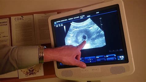 6 Weeks Twins Ultrasound Youtube