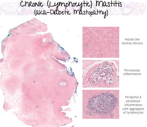 High Yield Review Inflammatory Breast Lesions