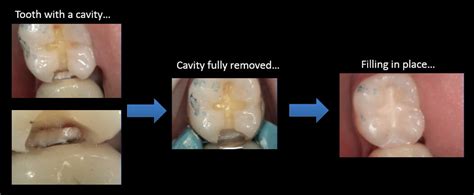 Experts say that it occurs when you take lots of energy drinks or soda pop. What Does a Cavity Look Like? | Mint Hill Dentistry