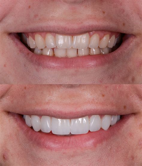 Composite Resin Veneers Buying Or Starting A Dental Practice