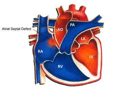Atrial Septal Defect - Pediatric Heart Specialists