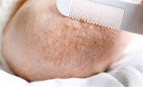 Cradle Cap — Fora Dermatology General And Surgical Dermatology In