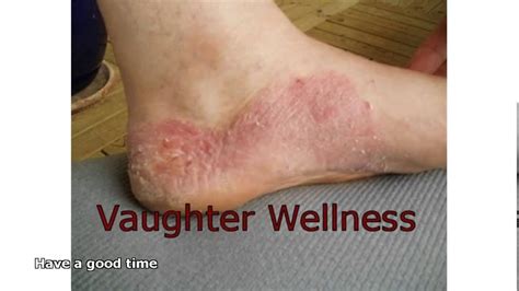 Foot Fungal Infection Youtube
