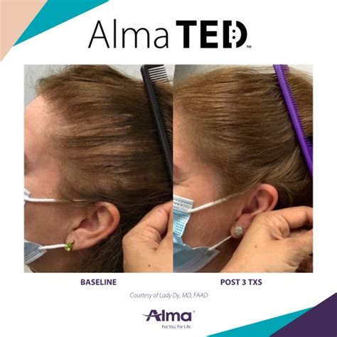 Alma Ted Hair Loss Treatment Non Invasive Cleveland Oh