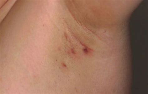 Red Lumps Underarm Armpit Lump Systemic Inflammation Armpit Cyst