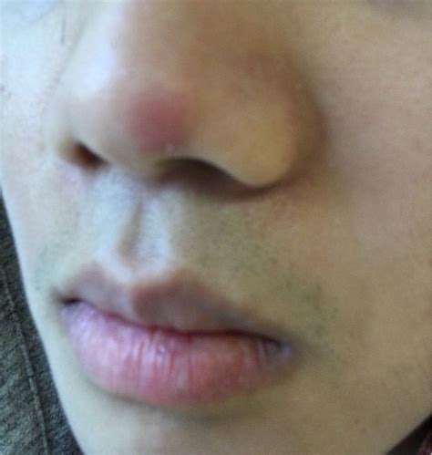 Skin Bump On Nose