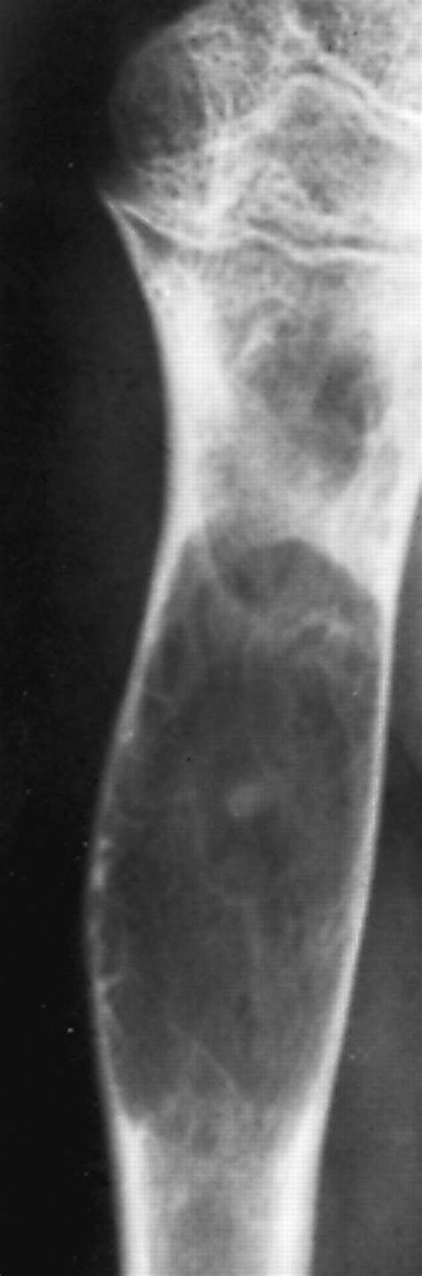 Bubbly Lesions Of Bone Ajr