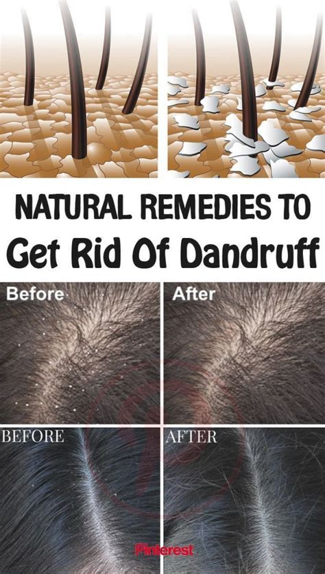 How To Get Rid Of Dry Scalp Best Home Remedies Remède Contre Les