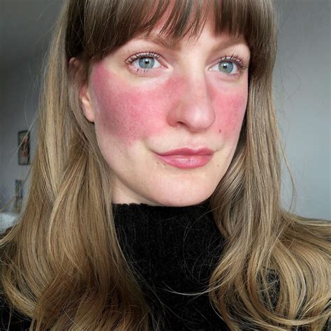 We know that you might have your preferences and criteria for choosing the most suitable cleanser. 11 People Describe What It's Really Like to Have Rosacea ...