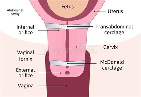 Verkrapping Van De Cervix Opening In De Transbuik Tijdens De Zwangerschap Anatomie Van Cervix