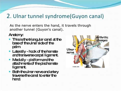 Guyons Canal Syndrome Treatment Captions Cute Viral