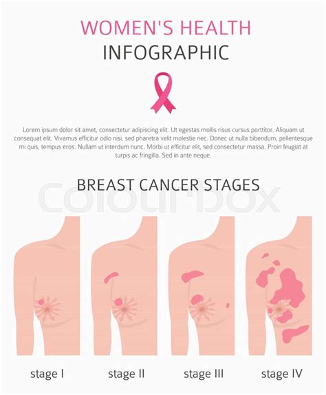 Breast Cancer Medical Infographic Stock Vector Colourbox