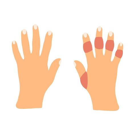 Hands With Rheumatoid Arthritis Disease In Cartoon Flat Style Vector
