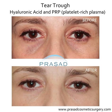Under Eye Filler Before And After Photos Prasad Cosmetic Surgery Ny