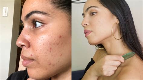 Before And After Acne Results After Getting A Lymphatic Massage Youtube