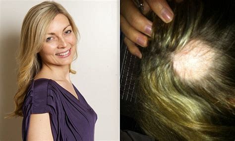 It usually stops after six months. Sudden hair loss hits millions of women and no one knows ...