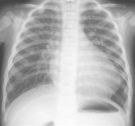 Aortic aneurysm fact sheet. mayo clinic: PLAIN RADIOGRAPHIC DIAGNOSIS OF CONGENITAL HEART DISEASE