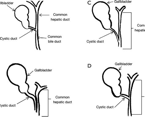 Anatomic Variations Of The Cystic Duct A Cystic Duct Normal B