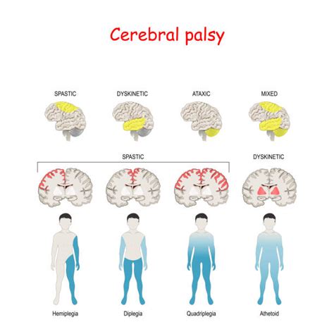 Parents Guide On Cerebral Palsy In Children