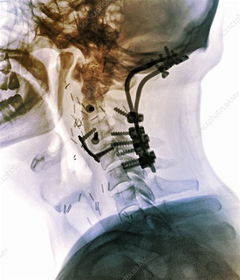 Fixed Broken Neck X Ray Stock Image C0269908 Science Photo Library