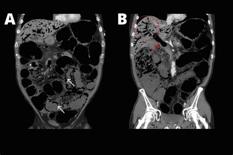 Cureus Tube Feeding Related Bowel Ischemia Presenting As Extensive