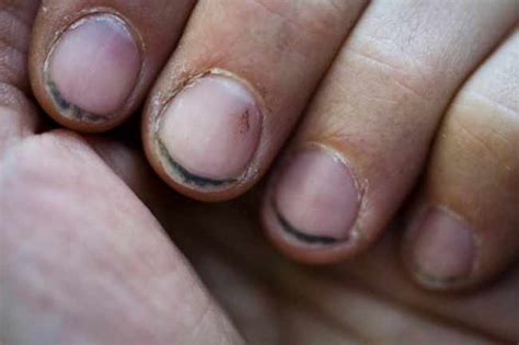 Damages Chronic Nail Biting Can Cause