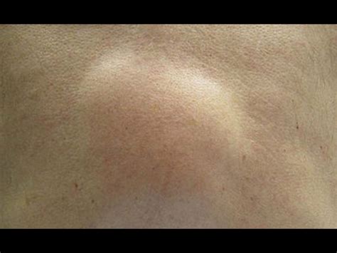 What Causes Armpit Lumps These Cysts And Bumps Can Be Painful Small