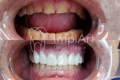 Bruxismoantesdepoiscoroasceramicas1 Implantes Dentários E