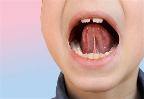 子どもの歯並び｜日吉の歯医者「矢島歯科医院」舌トレーニングで口呼吸から鼻呼吸へ