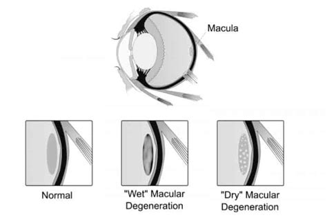 Macular Degeneration Symptoms Treatments And Laser Surgery