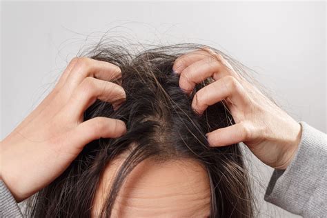 What Causes Flaky Scalp And Hair Loss Home Design Ideas